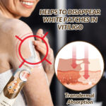 Sumifun White Spot Cream, Vitiligo Removal Cream 20g