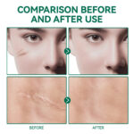 Elaimei Advanced Scar Gel 50ml 11 Elaimei Advanced Scar Gel 50ml
